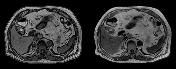Axial T1w in/out phase